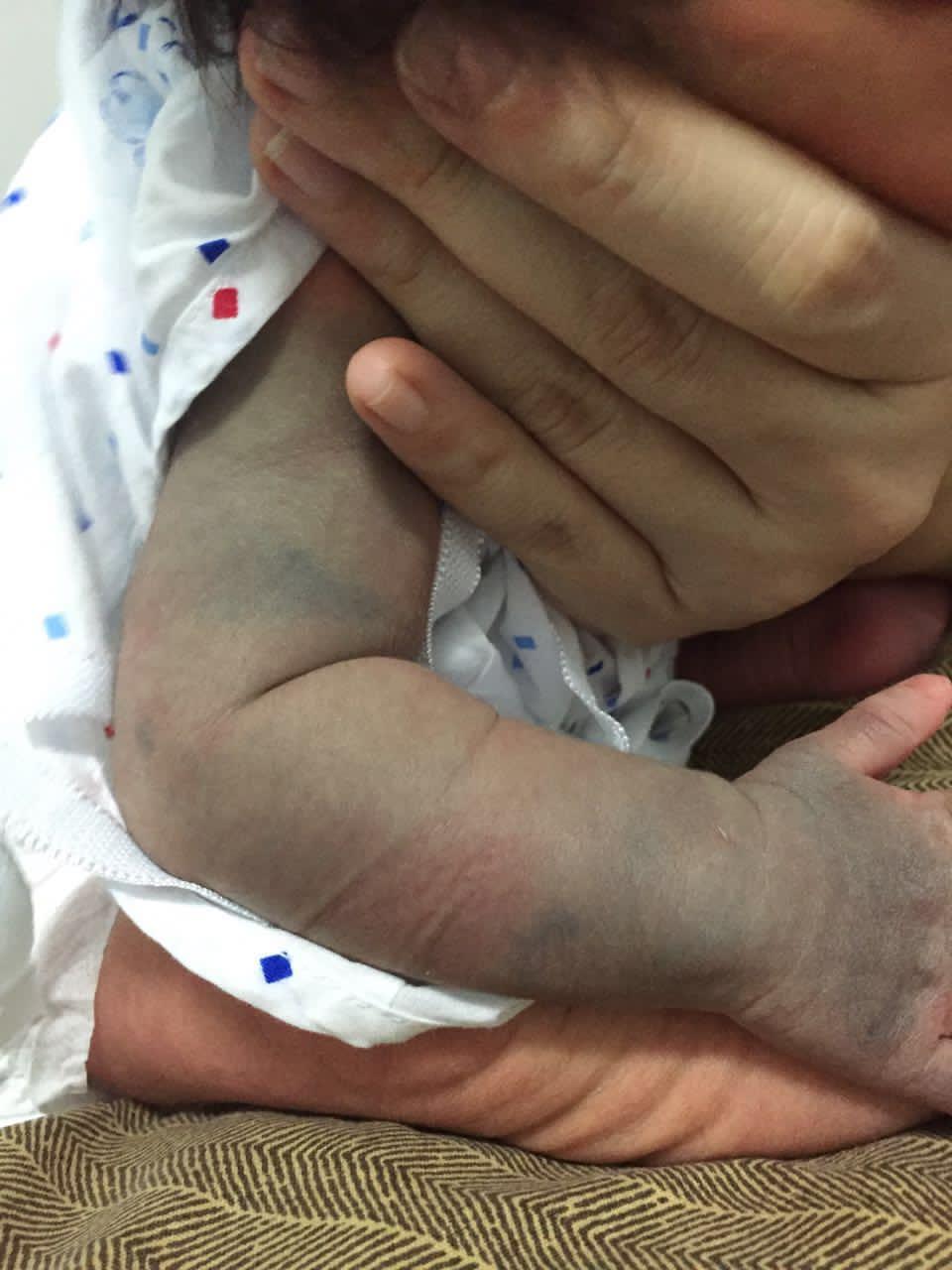 2个月左右的宝贝手上有如此青斑,请问是否会随着年龄增长褪去?