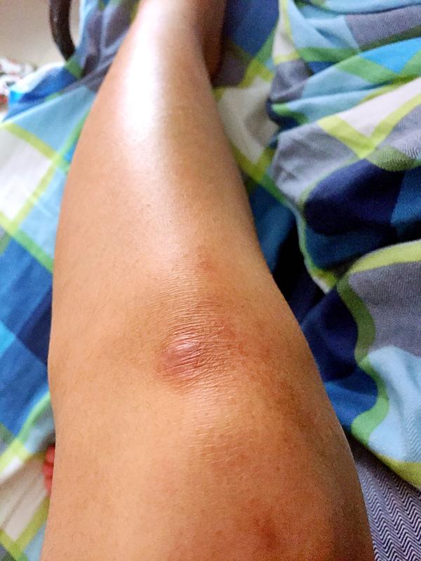 腿上有个小时候淘气留下的疤痕,夏天穿短裙子,短裤露出来大家会嘲笑我