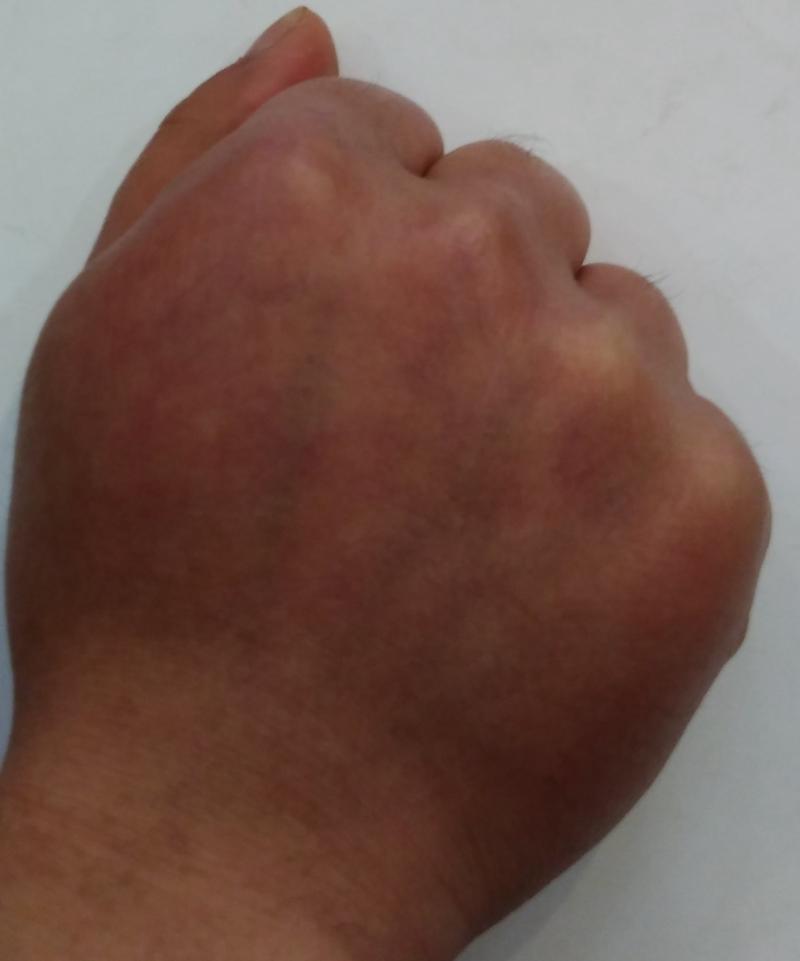 甲减导致的粘液性水肿怎么减呀求助