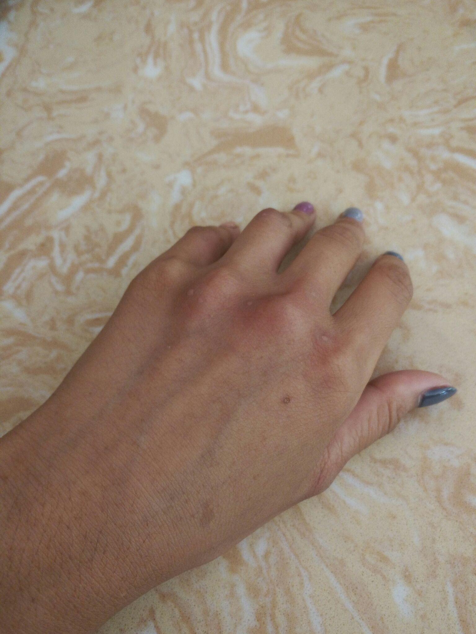 扁平疣冷冻治疗