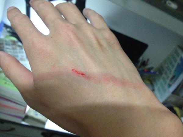 黄金右手 花样作死爱好者=各种留疤