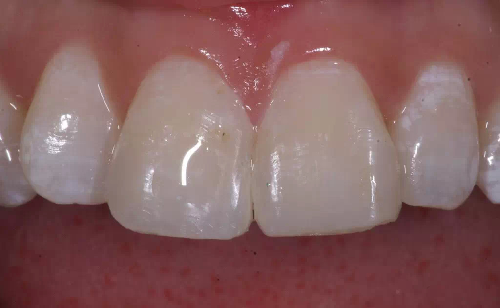 轻度氟斑牙怎么治疗比较好