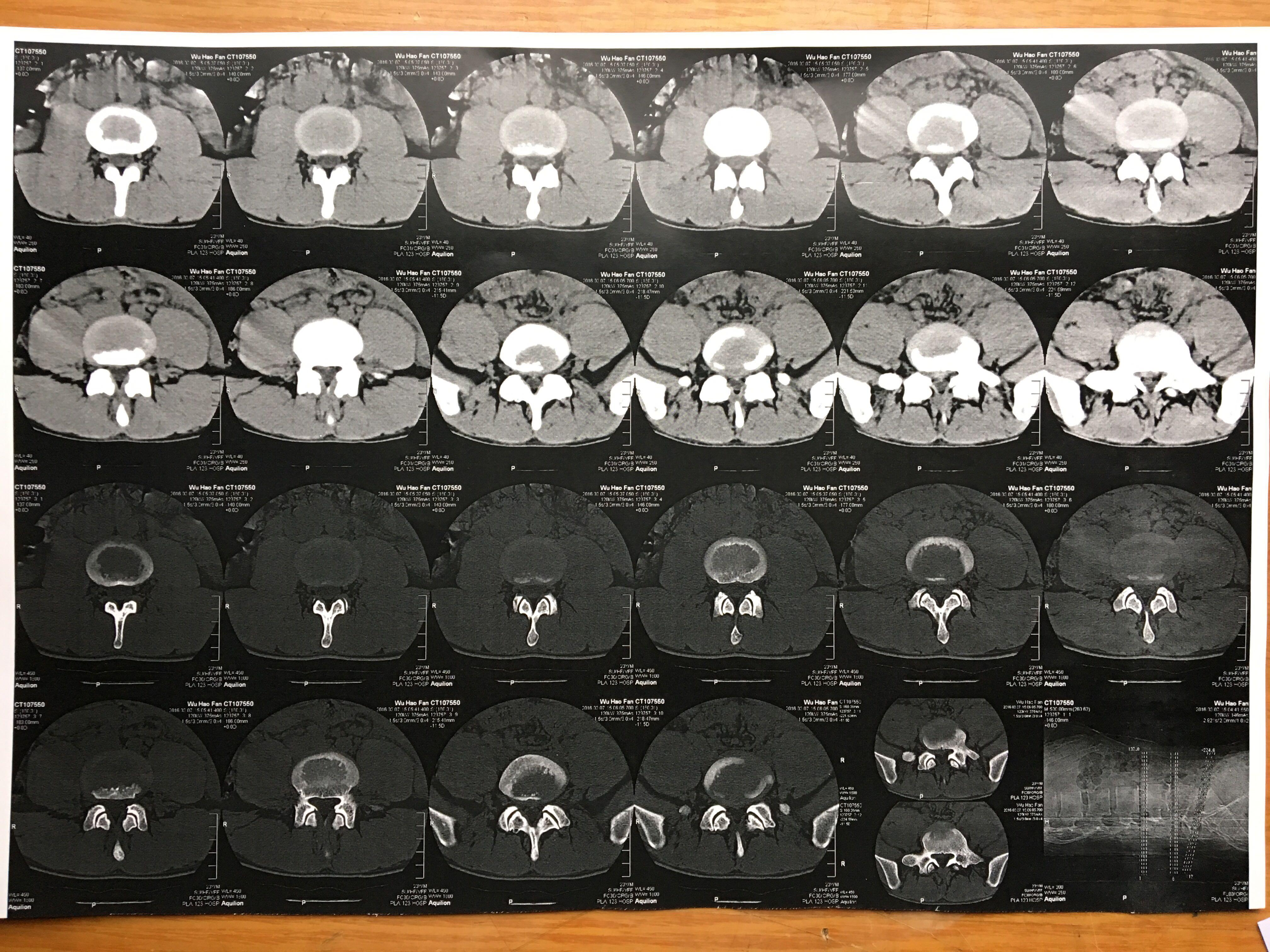 轻度腰椎间盘右侧肌筋膜炎