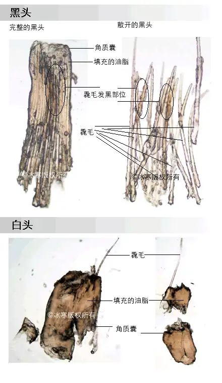 為什麼皮膚會長脂栓和黑頭如何控制它們產生