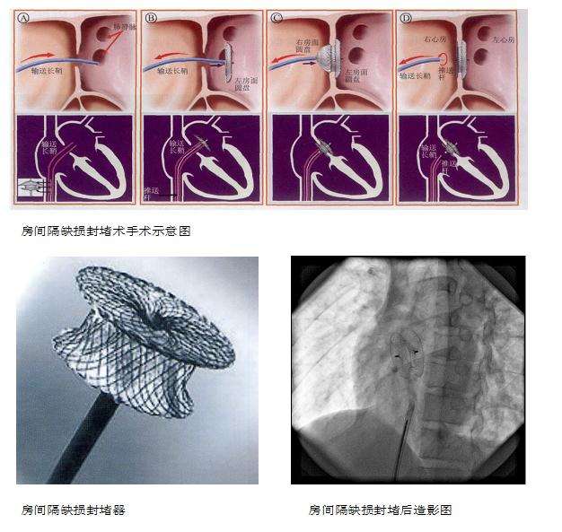 房缺封堵器图片