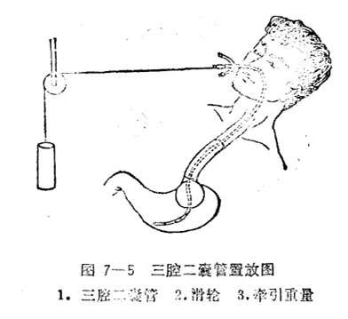 叫三腔二囊管,有个病人做了之后第二次胃出血的时候宁可死也不要做