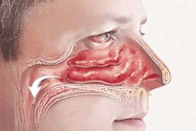 那另外一片肺岂不是在鼻塞期间都瘪着?