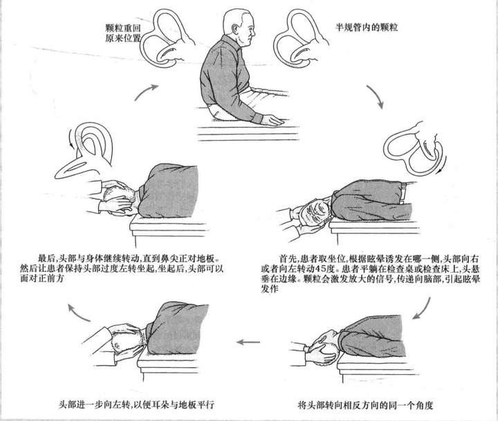 很多病友清晨醒来在枕头上转头,或者头后仰望高处的时候5-10秒内就会