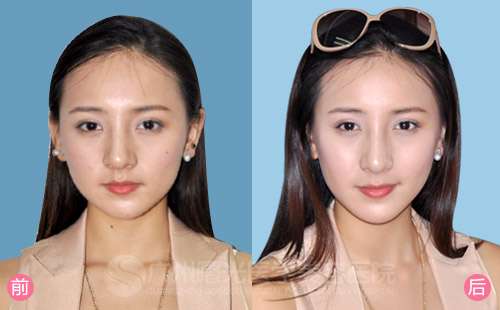                 瘦脸针前后对比