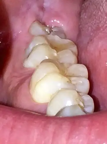 长了一颗智齿牙齿部分没有全露出来大部分在牙龈里要拔吗