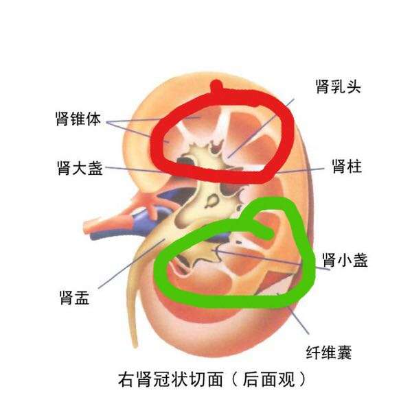 倒立排出肾结石是什么原理?