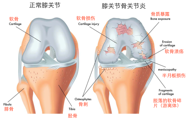 软骨专题 关节软骨损伤的治疗 知乎