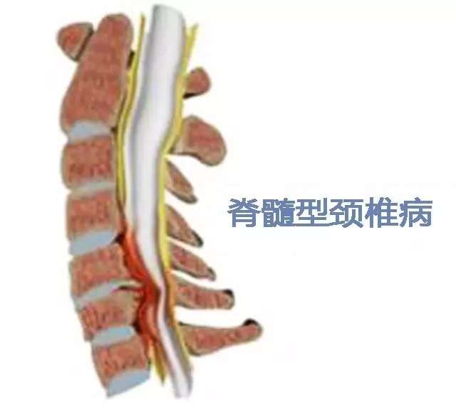 真正导致瘫痪的颈椎病 竟然是这些症状 很多人都没想到 知乎