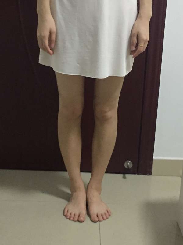 骨盆前倾股骨内旋型o型腿应该松解臀中肌吗