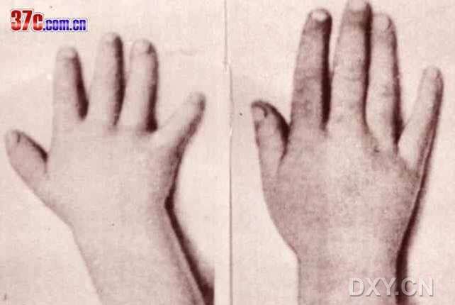 发现是球型晶状体,医生认为可能是marchesani综合征,请问此类遗传病
