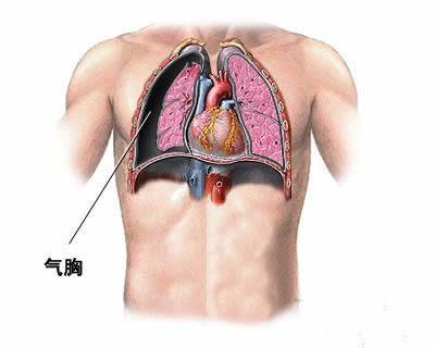 气胸疼痛位置图图片