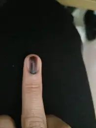 指甲上有一条淡淡黑线,怎么回事?两年了. - 知乎
