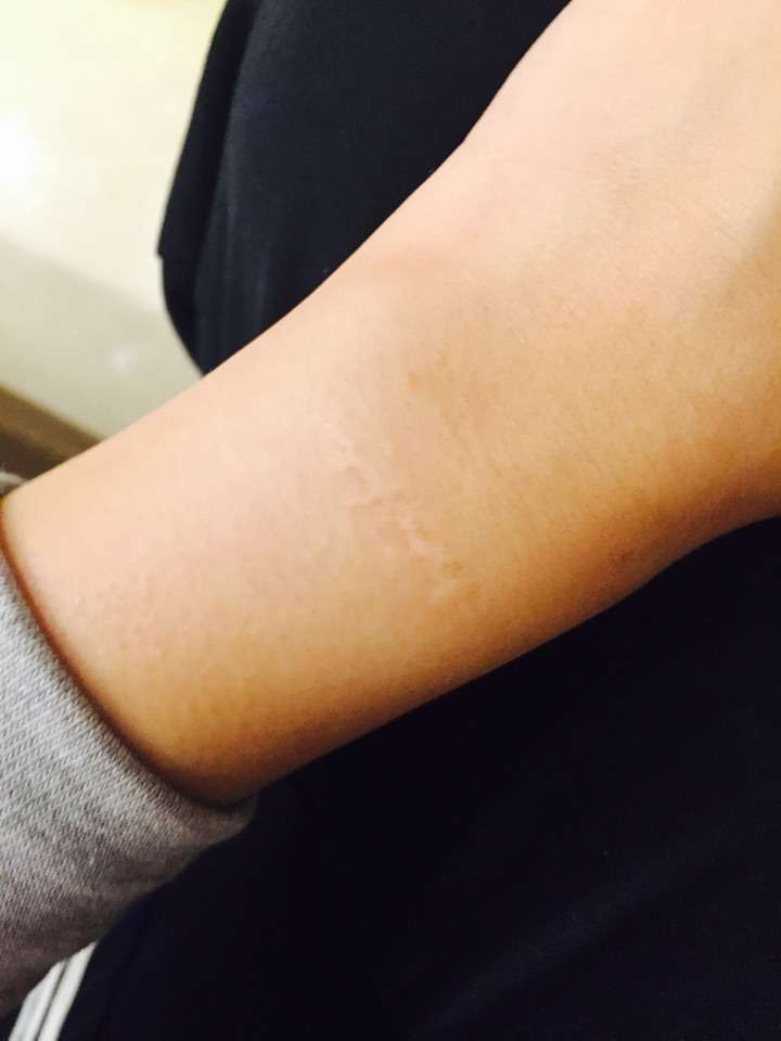 接下来是我手上的疤,,,献丑了