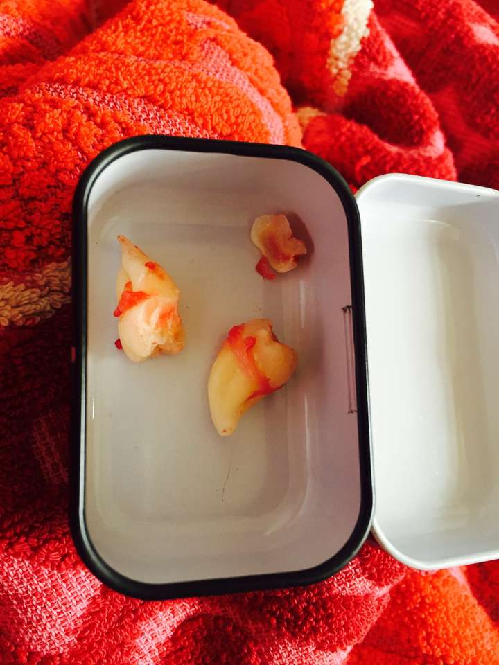 求助大家,尽头牙是倒着的,这种情况是不是必须拔掉