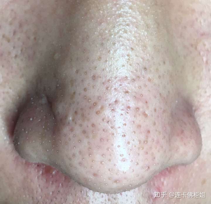 脸部三角区,鼻孔两侧油脂粒如何根除?