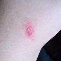 皮下出血- 知乎