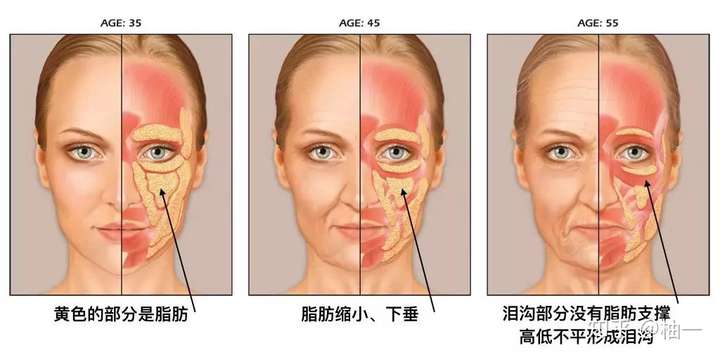 拿掉滤镜,比黑眼圈眼袋更可怕的是泪沟和法令纹!(图10) 拿掉滤镜,比黑眼圈眼袋更可怕的是泪沟和法令纹!(图10)