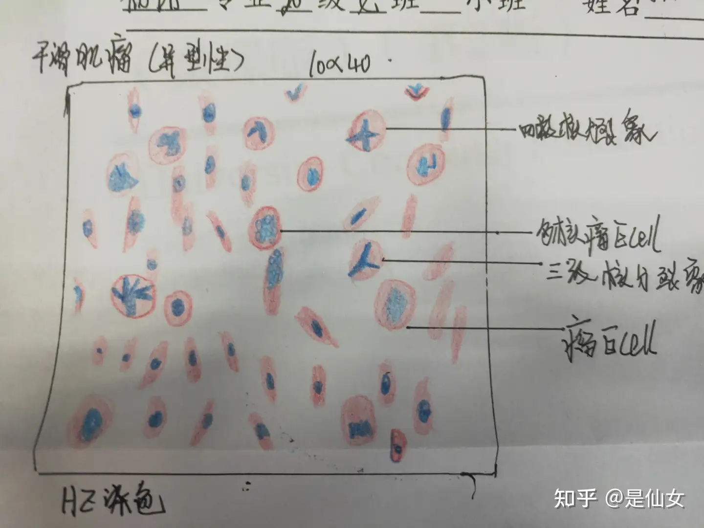 病理学红蓝铅笔绘画图实验课题: 平滑肌瘤与鳞状上皮细胞癌- 知乎