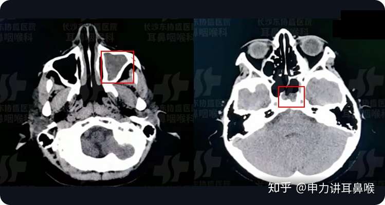 和 科 里 耳鼻