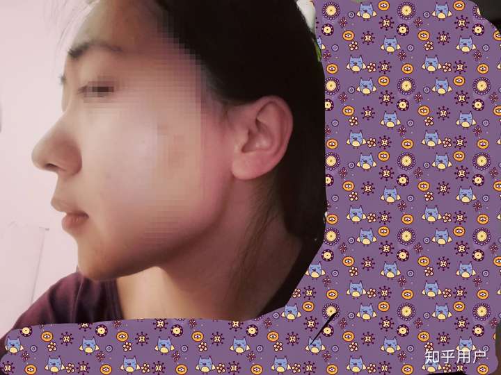 鼻子高但是山根低是什么样?