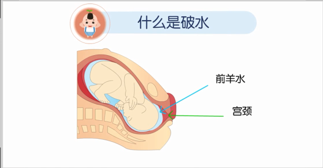 关于破水的那些事儿 你知道多少 知乎