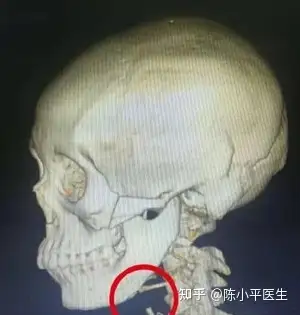 如果下颌角角度过小接近于90度,而且耳根到下颌角距离过长时,那基本就