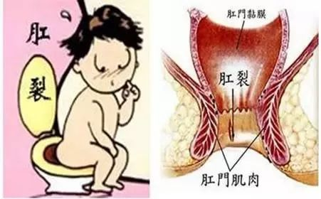 广州东大肛肠医院收费好不好肛裂会不会传染呢？