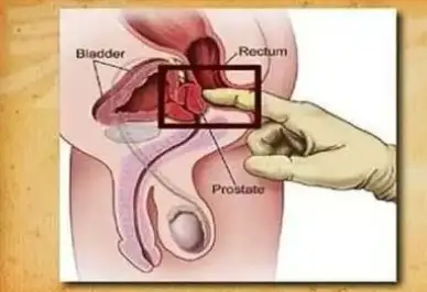 取前列腺液手法图解图片