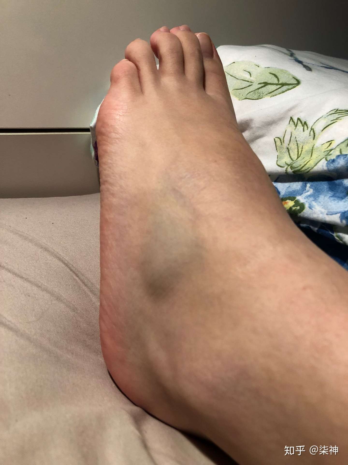 脚踝韧带手术和康复历程1 知乎