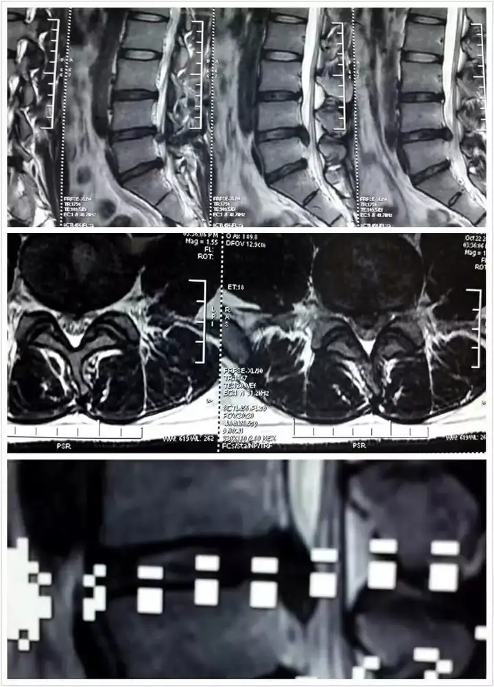 腰5椎体1度滑脱严重吗?腰椎滑脱日常需要注意什么?插图3 腰5椎体1度滑脱严重吗?腰椎滑脱日常需要注意什么?插图3