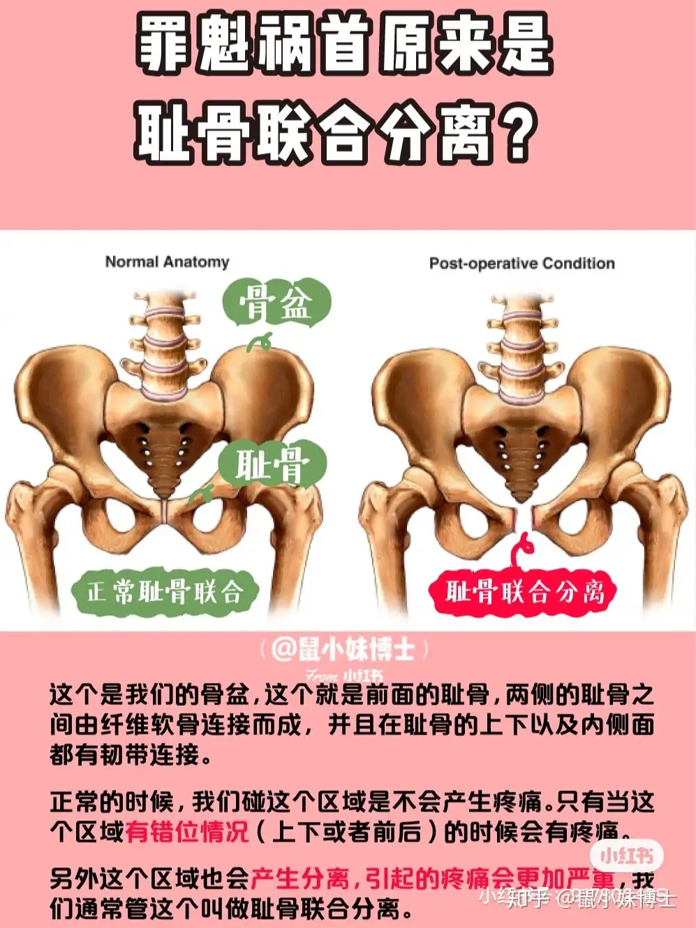 耻骨联合分离的原因及危害 知乎