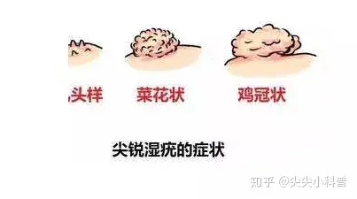 运动时会受到摩擦,排便时会有出血,有部分患者会当时痔疮来治,而让疣