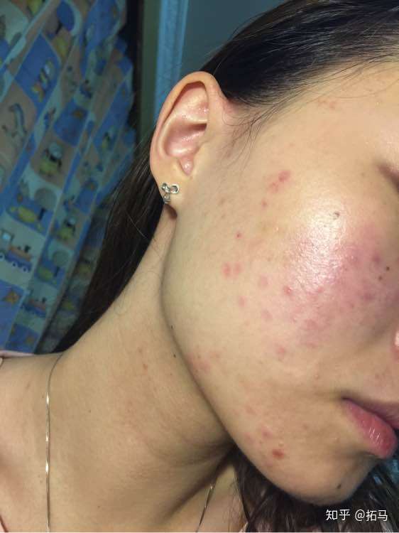 前几天脸上突然爆痘痘现在成这样了求救啊