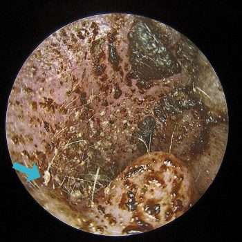 由于各种原因导致的外耳道炎症,就是外耳炎了,犬猫可能会有耳屎变多