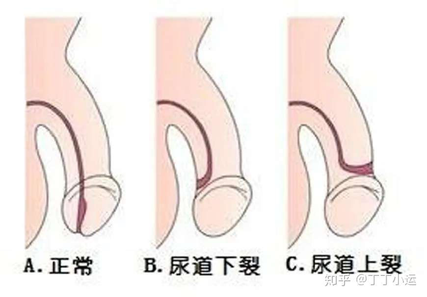 尿道口长错了怎么办 尿道下裂的诊疗指南 知乎