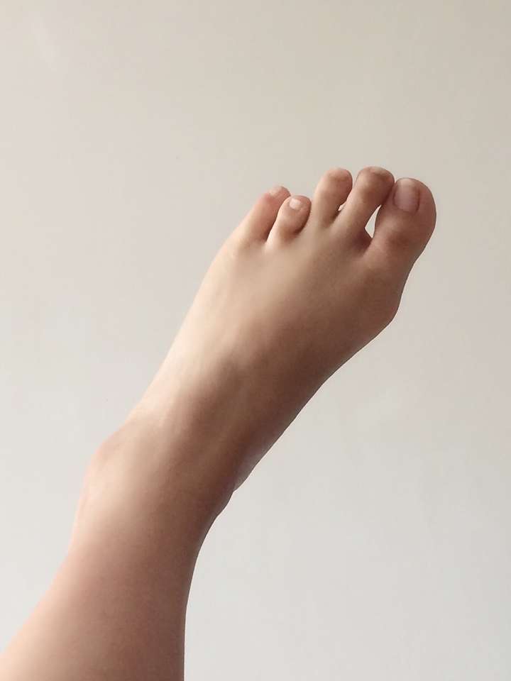请问有人是第四脚趾短小症吗?