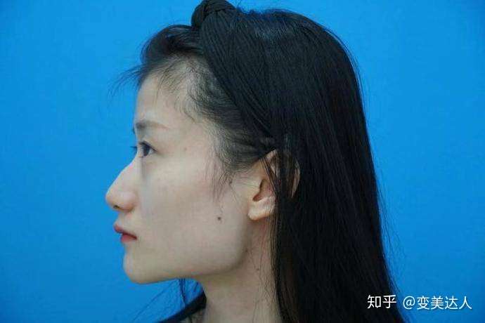 大家就知道我为什么回来做下颌角手术了,我真的是标准的国字脸,正的不