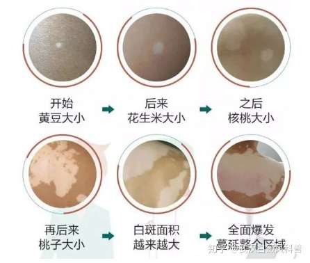 一拖再拖的白癜风最终会变成什么样子