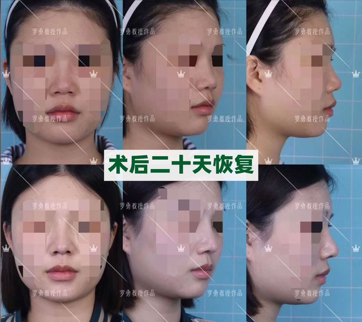 矯正 小鼻