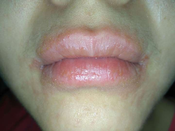 嘴唇唇炎症状图片图片