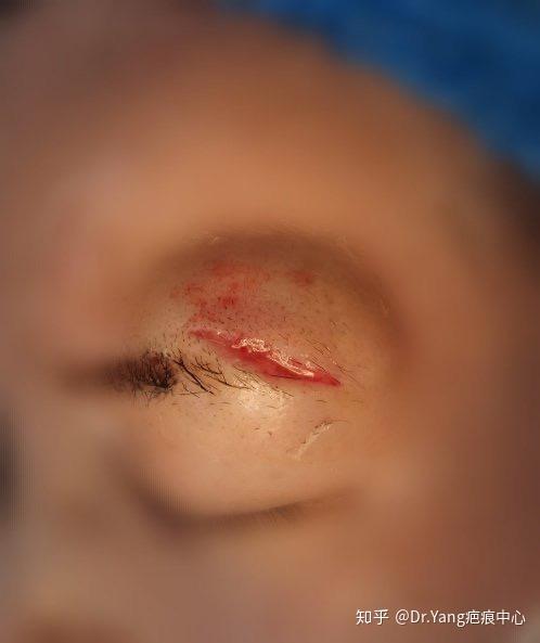 一例眉部外伤急诊美容缝合术后恢复情况