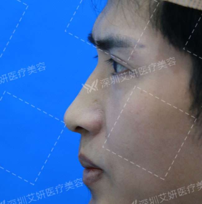 宽鼻案例3 屌丝逆袭成男神 这才是帅哥的行走方式 知乎