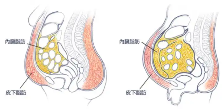 根据脂肪堆积的部位不同,肥胖被分为两种类型 :一种是皮下脂肪型肥胖