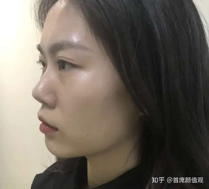 这样的鼻子山根低吗?