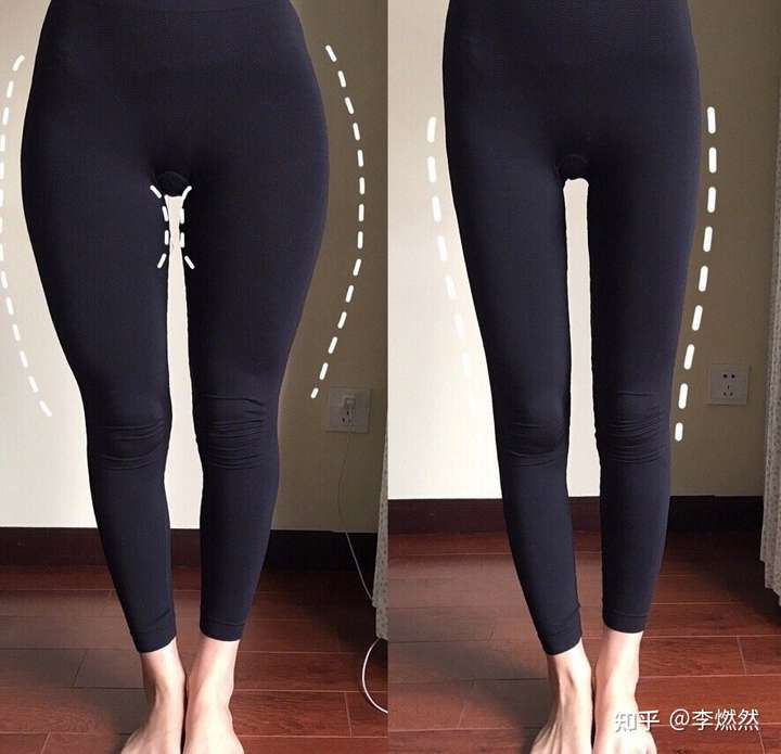 大腿吸脂真的有效果么?